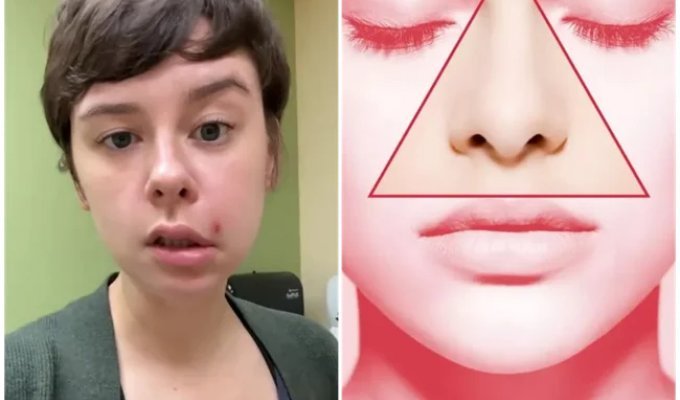 Американка выдавила прыщ - и попала в больницу с перекошенным лицом (3 фото)