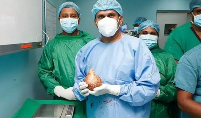 In Sri Lanka, a man had the largest kidney stone removed in the world (4 photos)