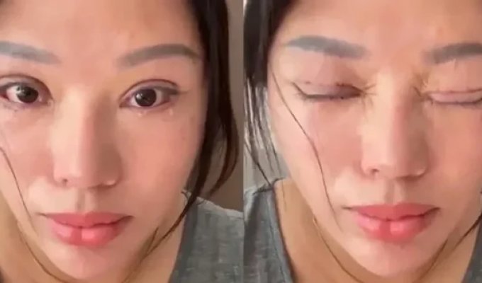 Six Years Without Sleep: A Girl Had a Popular Cosmetic Procedure, But Everything Went Wrong (3 photos)