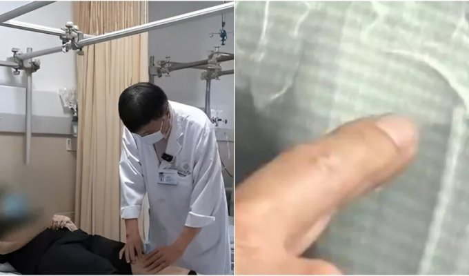 A 35-year-old Chinese man broke his femur as a result of coughing (3 photos)