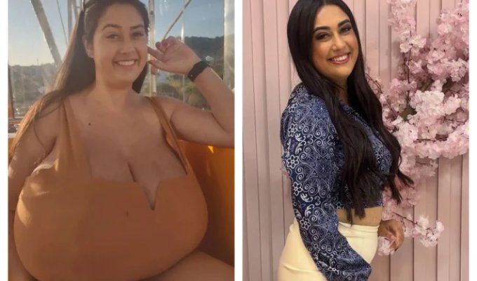 I couldn't stand it anymore: a Brazilian woman had her breasts cut off after they grew to gigantic sizes (5 photos + 4 videos)