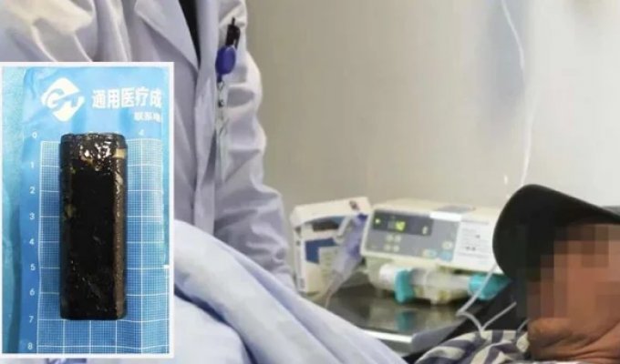 Врачи извлекли зажигалку из желудка мужчины, который в пьяном угаре проглотил её 30 лет назад (5 фото)