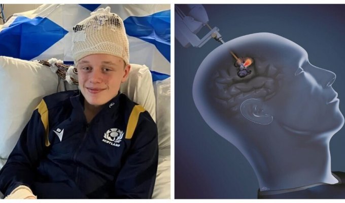 Removal of brain tissue helped an epileptic teenager return to normal life (5 photos)
