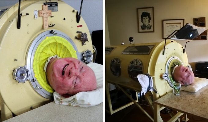 Man with iron lungs dies at age 78 (6 photos)