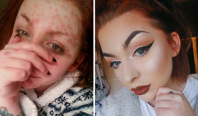 Чудеса макияжа: девушка с «кожей-чешуей» вдохновляет больных псориазом волшебными преображениями (12 фото)