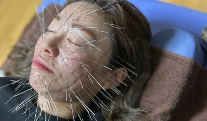 Fashionable Acupuncture Technique Turns People Into Porcupines (5 photos)