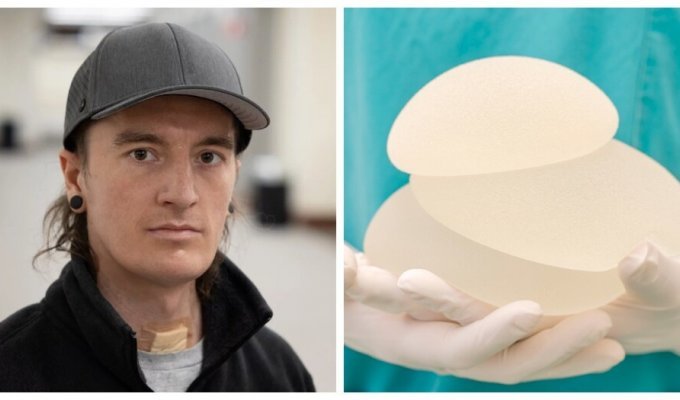 Unconventional use of breast implants saved a young man’s life (7 photos)