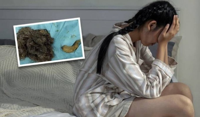 14-year-old girl from China tore out and ate 3 kg of hair (3 photos)