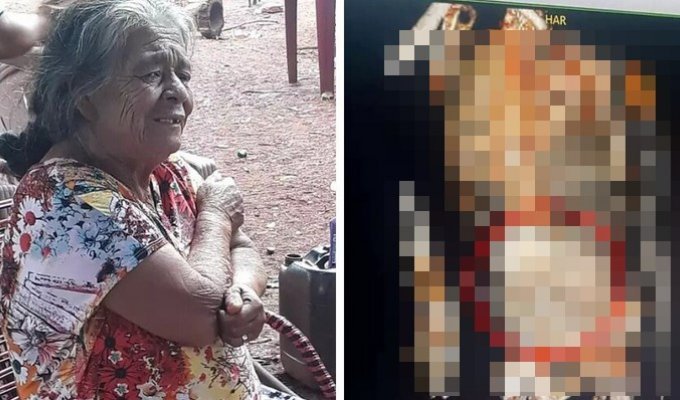 81-річна жінка 56 років прожила з «кам'яною дитиною» у животі (4 фото)