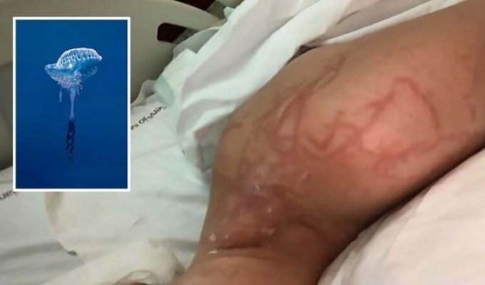 Женщина получила ужасные травмы после того, как её укусила медуза (5 фото)