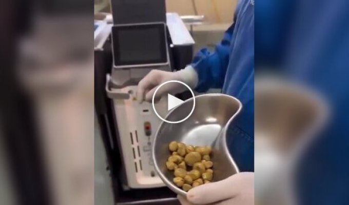 Медики извлекли десятки камней из мочевого пузыря любителя сладкой газировки