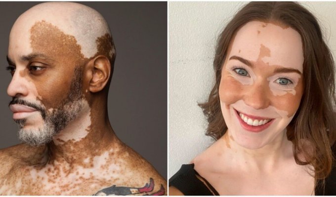 Special people with vitiligo who are no longer ashamed of themselves and their bodies (15 photos)