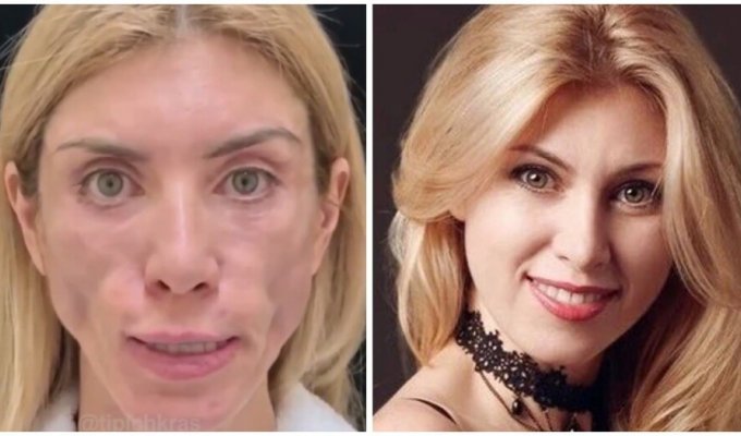 A model from Sochi disfigured by plastic surgery sued the clinic for 80 thousand dollars (3 photos + 1 video)