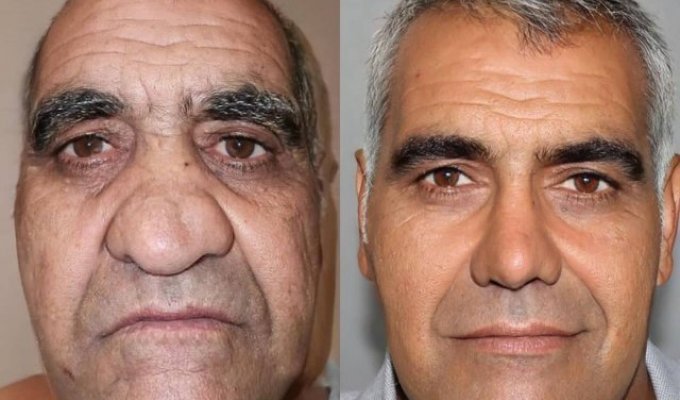 How modern plastic surgery changes men (4 photos)
