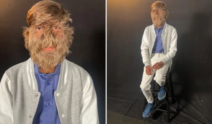 One in a billion: what an unusual teenager with werewolf syndrome looks like (1 photo + 2 videos)