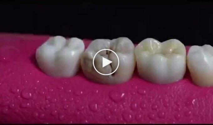 How to treat a tooth for caries with nerve removal