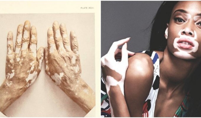 Blank spot in medicine: the history of vitiligo (8 photos)