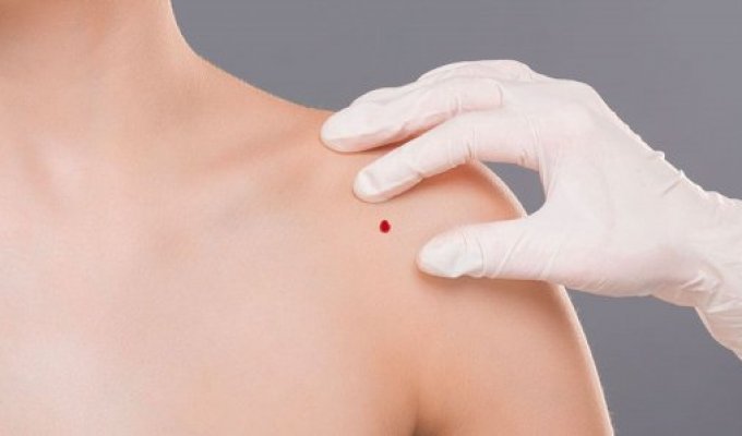 Почему появляются ангиомы во взрослом возрасте?