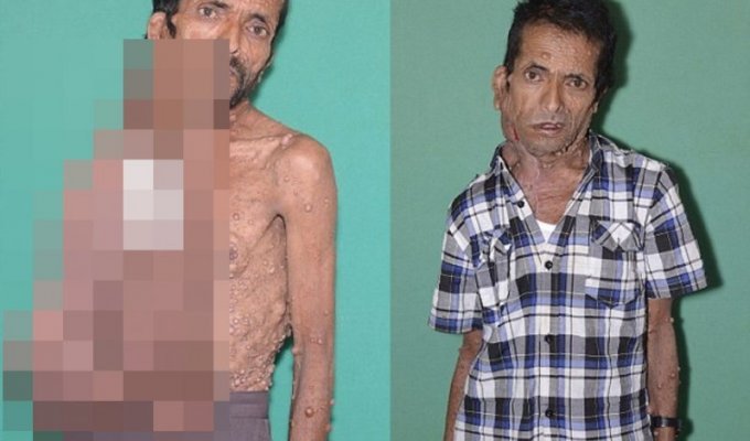 Непальцу удалили огромную опухоль на лице, с которой он прожил 47 лет (8 фото)