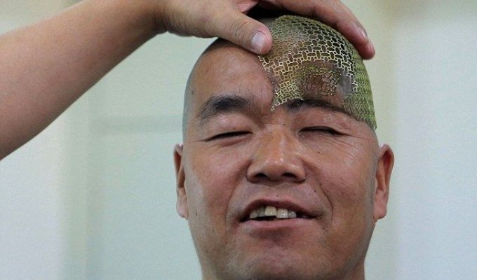 Врачи распечатали китайскому фермеру новый череп (5 фото) (жесть)