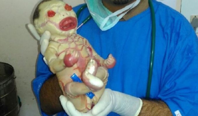 В Индии родилась девочка, на которой почти нет кожи (4 фото)