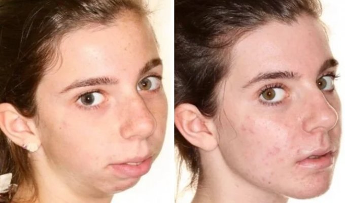 A Whole New Person: 22 Stunning Before-and-After Plastic Surgery Transformations (22 photos)