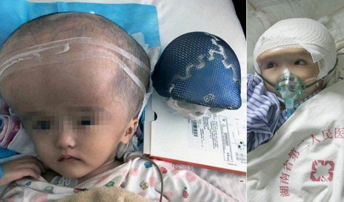 3-летней девочке в Китае пересадили череп, напечатанный на 3D-принтере (8 фото)