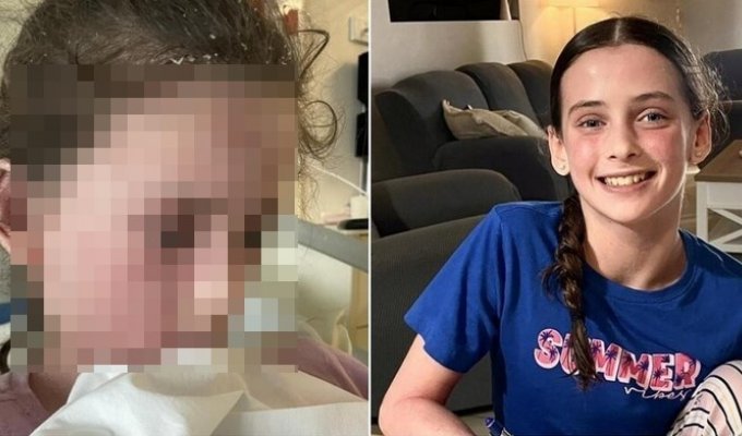 An 11-year-old girl developed an allergy to her own tears and sweat (6 photos)