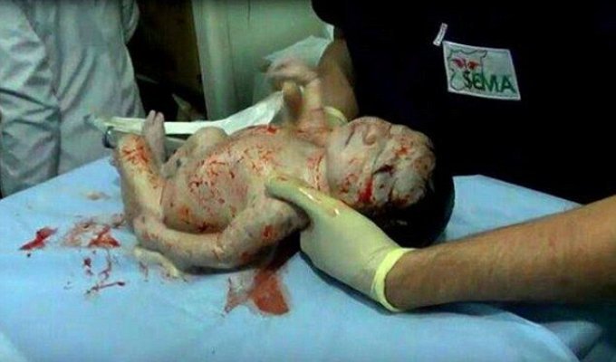 Сирийские врачи спасли младенца, родившегося со шрапнелью в голове (3 фото)