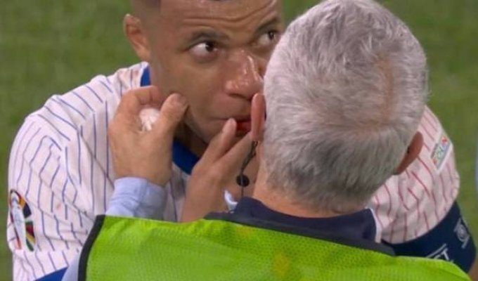 Mbappe broke his nose at Euro 2024 (3 photos)