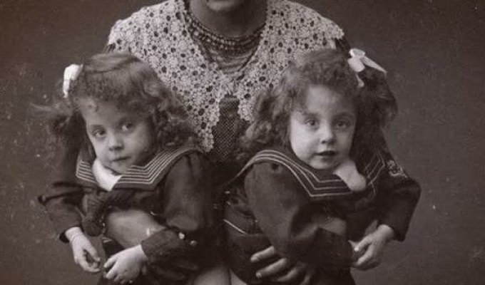 Трагичная судьба сиамских близнецов Дейзи и Виолетты Хилтон, всю жизнь проживших вместе (30 фото)