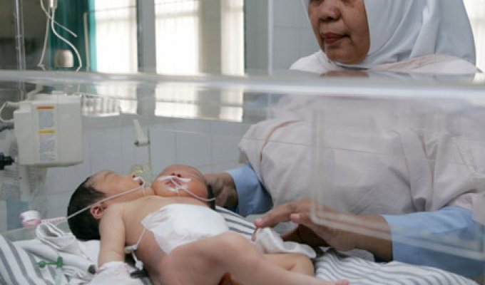 В Индонезии родился двухголовый ребенок (3 фотографии) Слабонервным не смотреть!