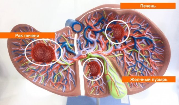 Рак печени и его симптомы