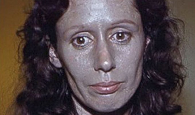 После применения капель для носа женщина покрылась серебряным панцирем (4 фото)