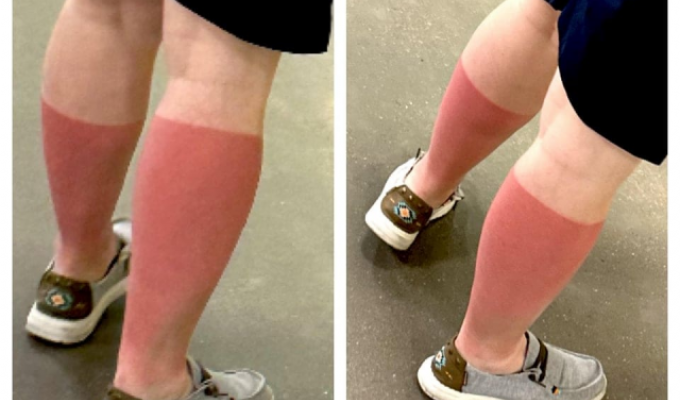 Toasted: a selection of funny and disastrous tan (15 photos)