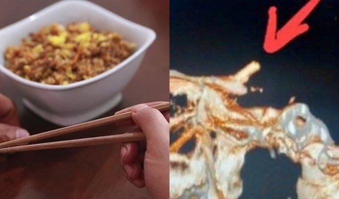 A Vietnamese man complained of a headache and did not know that he had chopsticks in his skull (3 photos)