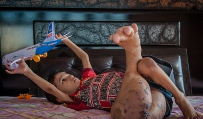 Нога индийского мальчика выросла вчетверо больше нормы (4 фото)