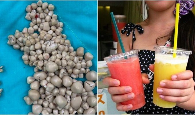300 kidney stones removed from a sweet drink lover (3 photos)