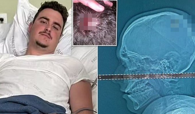 A Brazilian celebrated the New Year for several days with a bullet in his head (5 photos)